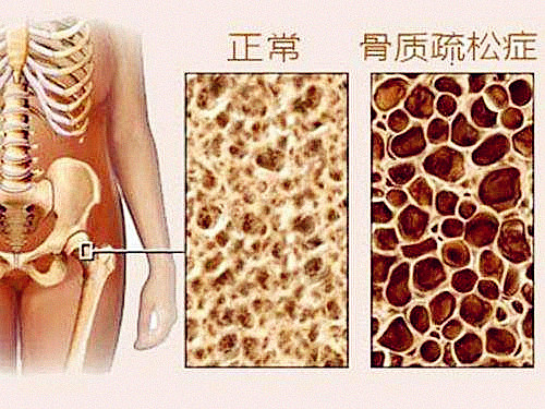 它骨骼強度的主要指標、簡單方便、安全靠譜對骨代謝有很重要作用