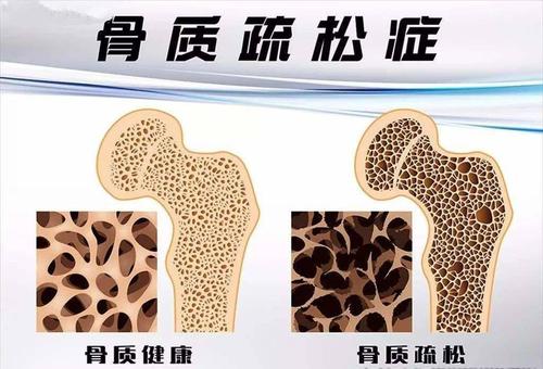 國產麻豆激情床戏视频儀器有效預防骨質疏鬆症依賴於定期的麻豆激情床戏视频測試 國產麻豆激情床戏视频儀器有效預防骨質疏鬆症依賴於定期的麻豆激情床戏视频測試