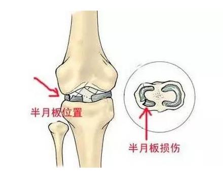 624河南信陽|亚洲国产精品麻豆超聲波麻豆激情床戏视频儀廠家今日資訊:了解並正確保護膝關節半月板