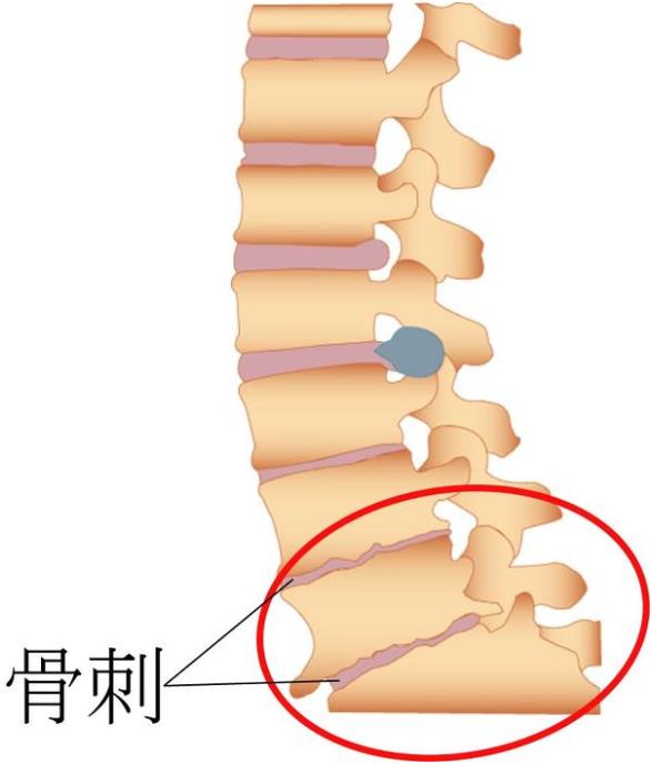 吉林長春|亚洲国产精品麻豆超聲麻豆激情床戏视频儀廠家品牌分享:為什麽現在的年輕人也存在骨刺增生?